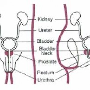 bladder cancer