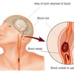What is a Stroke?