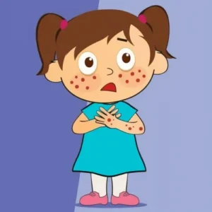 Chickenpox: What You Need to Know