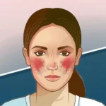 Lupus: Unmasking the Unpredictable Illness